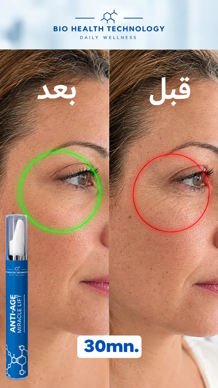 Miracle Lift avant / après, ridules du contour des yeux